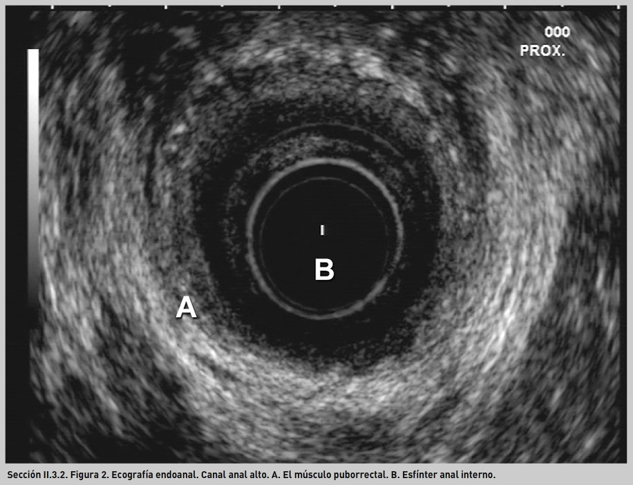 Ecografía anal y rectal