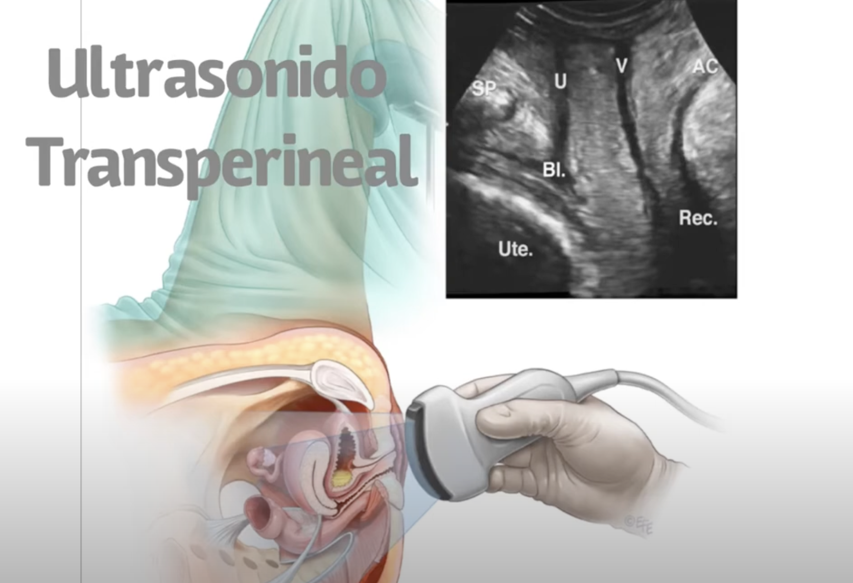 Tropis: nuevo tratamiento quirúrgico de la fístula anal