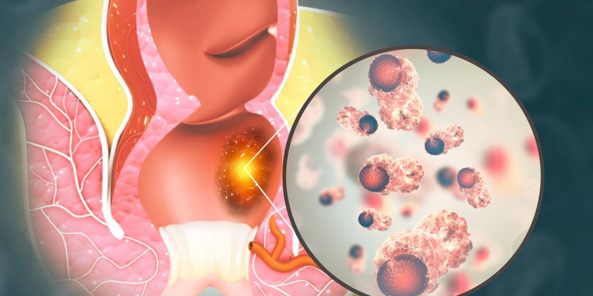 Diagnóstico temprano del cáncer de ano
