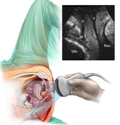 Ecografía trasperineal del suelo pélvico